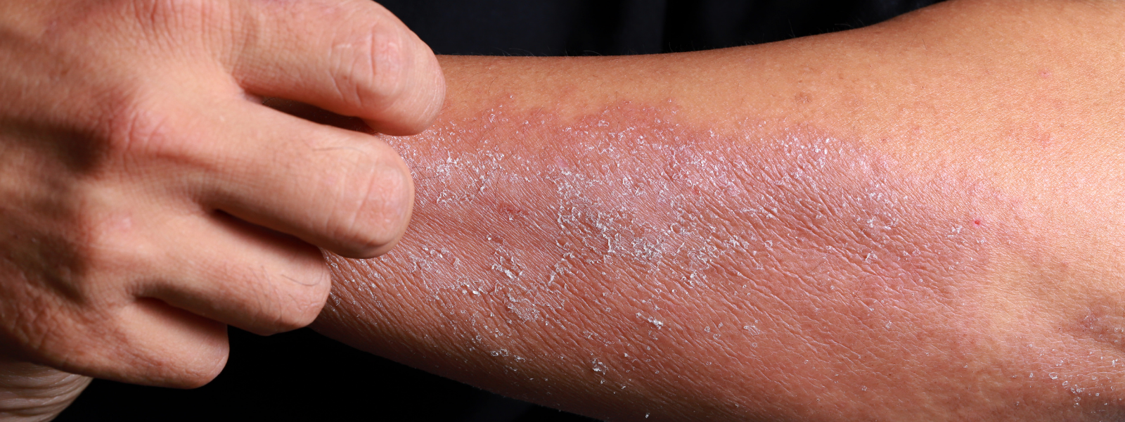 Everything you need to know Seborrheic Dermatitis