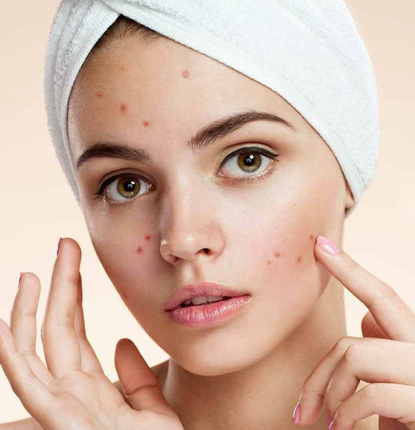 Everything you need to know about Acne