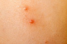 Everything you need to know Molluscum Contagiosum