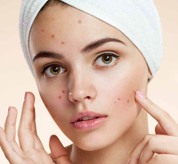 Everything you need to know about Acne