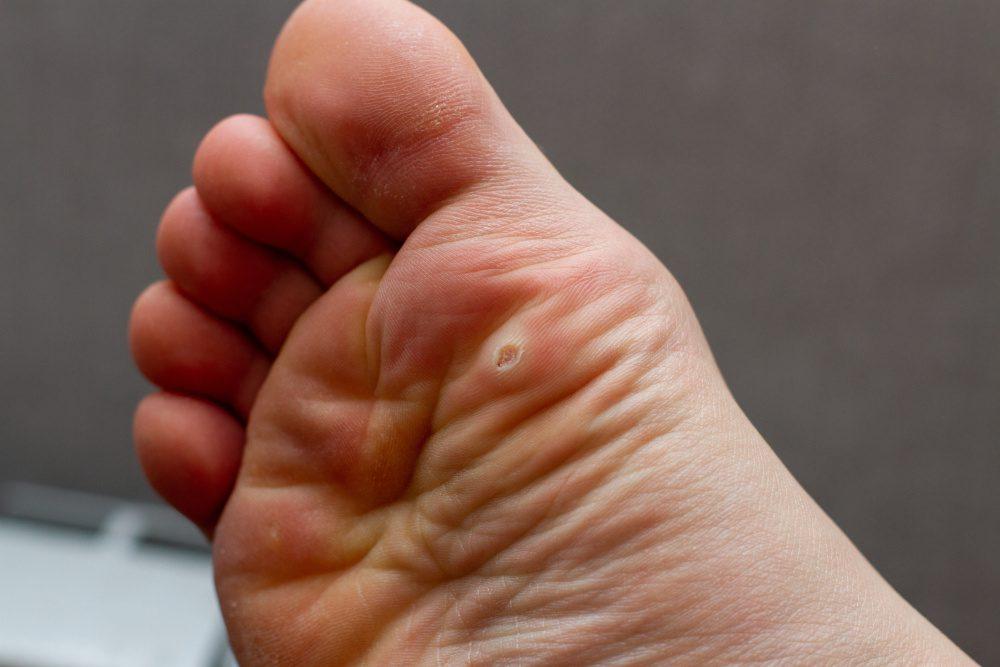 Everything you need to know about Warts