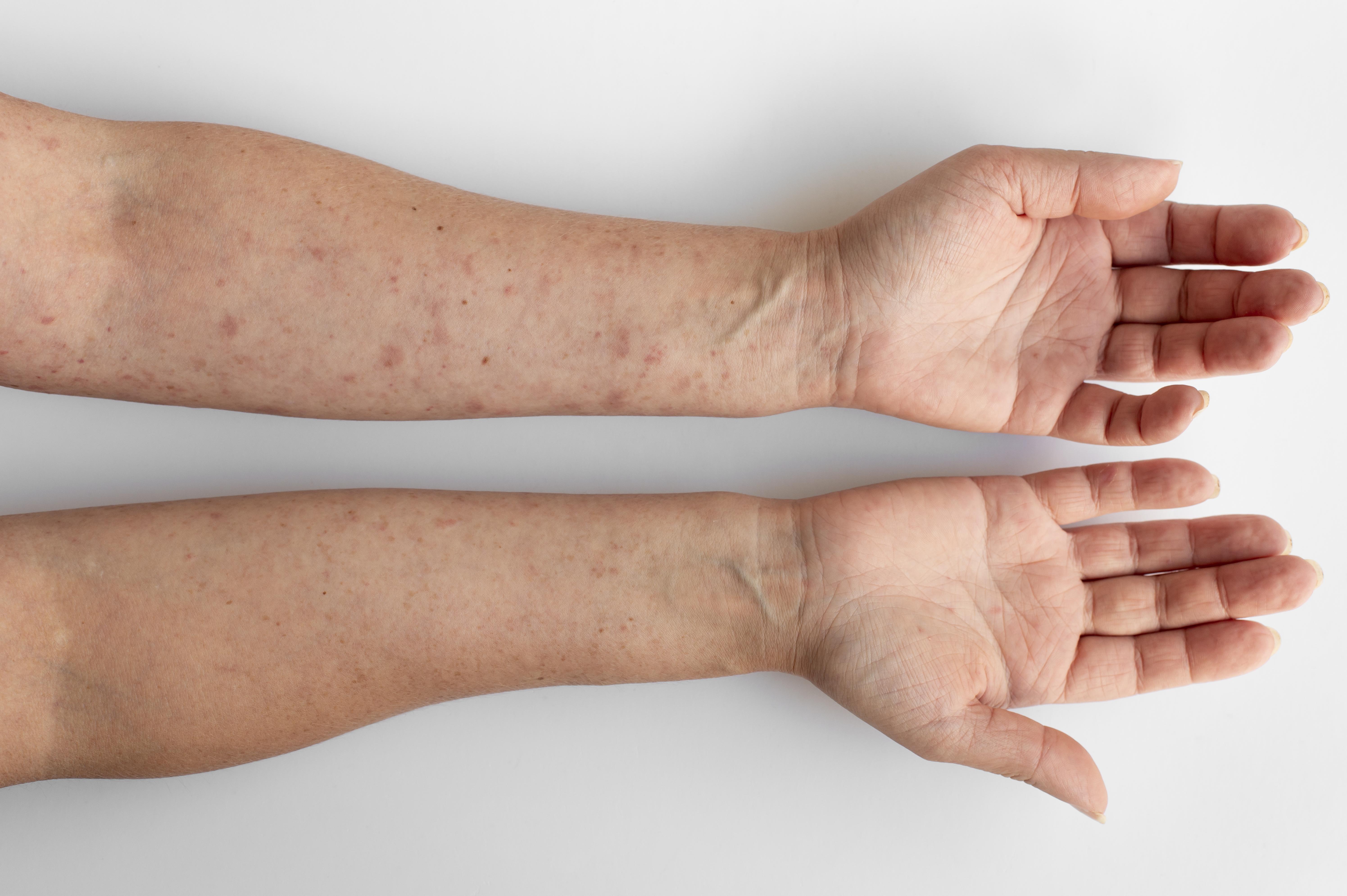 Everything you need to know Urticaria & Angioedema